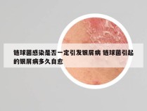 链球菌感染是否一定引发银屑病 链球菌引起的银屑病多久自愈