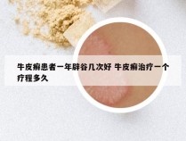 牛皮癣患者一年辟谷几次好 牛皮癣治疗一个疗程多久