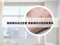 银屑病没谈过恋爱 银屑病可以找到真爱吗