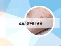 免疫力弱导致牛皮癣