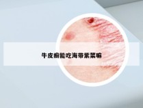 牛皮癣能吃海带紫菜嘛