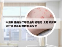 太原银屑病治疗哪里最好的地方 太原银屑病治疗哪里最好的地方最安全