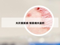 大片银屑病 银屑病大面积