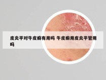 皮炎平对牛皮癣有用吗 牛皮癣用皮炎平管用吗