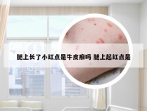 腿上长了小红点是牛皮癣吗 腿上起红点是