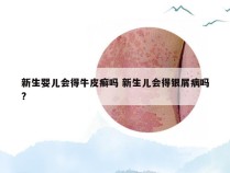 新生婴儿会得牛皮癣吗 新生儿会得银屑病吗?