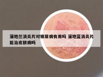 蒲地兰消炎片对银屑病有用吗 蒲地蓝消炎片能治皮肤病吗