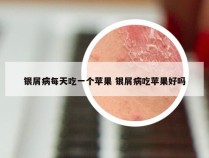 银屑病每天吃一个苹果 银屑病吃苹果好吗