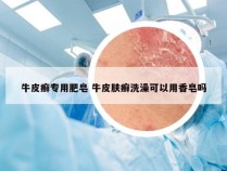 牛皮癣专用肥皂 牛皮肤癣洗澡可以用香皂吗