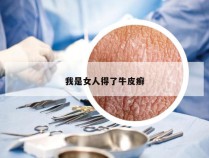 我是女人得了牛皮癣
