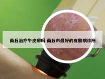 商丘治疗牛皮癣吗 商丘市最好的皮肤病诊所