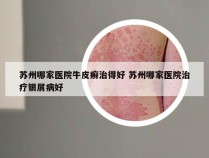 苏州哪家医院牛皮癣治得好 苏州哪家医院治疗银屑病好