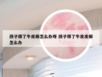 孩子得了牛皮癣怎么办呀 孩子得了牛皮皮癣怎么办