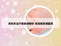 贵阳市治疗银屑病哪好 贵阳银屑病医院
