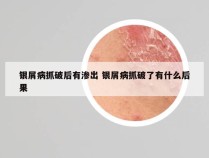 银屑病抓破后有渗出 银屑病抓破了有什么后果