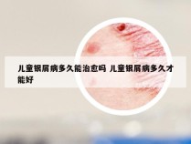 儿童银屑病多久能治愈吗 儿童银屑病多久才能好
