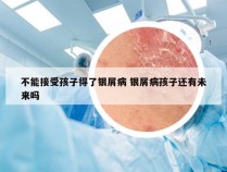 不能接受孩子得了银屑病 银屑病孩子还有未来吗