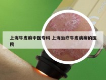 上海牛皮癣中医专科 上海治疗牛皮病癣的医院