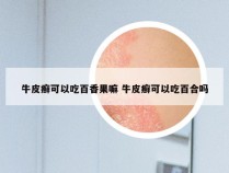 牛皮癣可以吃百香果嘛 牛皮癣可以吃百合吗
