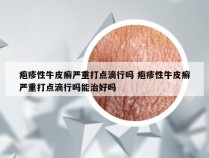 疱疹性牛皮癣严重打点滴行吗 疱疹性牛皮癣严重打点滴行吗能治好吗
