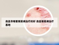 南昌市哪里银屑病治疗的好 南昌银屑病治疗基地