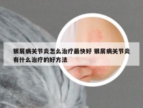 银屑病关节炎怎么治疗最快好 银屑病关节炎有什么治疗的好方法
