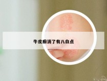 牛皮癣消了有八白点