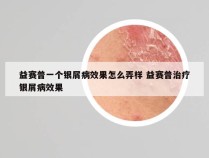 益赛普一个银屑病效果怎么弄样 益赛普治疗银屑病效果