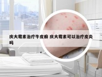 庆大霉素治疗牛皮癣 庆大霉素可以治疗皮炎吗