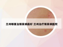 兰州哪里治银屑病最好 兰州治疗银屑病医院