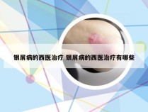 银屑病的西医治疗 银屑病的西医治疗有哪些