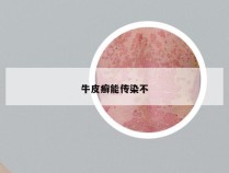 牛皮癣能传染不