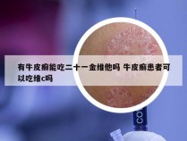 有牛皮癣能吃二十一金维他吗 牛皮癣患者可以吃维c吗