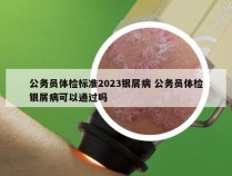 公务员体检标准2023银屑病 公务员体检银屑病可以通过吗