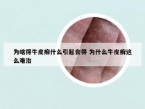 为啥得牛皮癣什么引起会得 为什么牛皮癣这么难治
