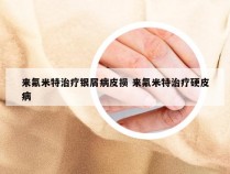 来氟米特治疗银屑病皮损 来氟米特治疗硬皮病