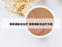 银屑病前沿治疗 银屑病前沿治疗方案