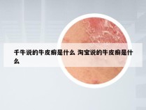 千牛说的牛皮癣是什么 淘宝说的牛皮癣是什么