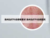 扬州治疗牛皮癣哪里好 扬州治疗牛皮癣医院