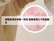 副银屑病会伴随一生吗 副银屑病三个阶段图片