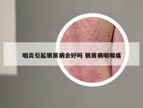 咽炎引起银屑病会好吗 银屑病咽喉痛