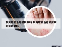 灰黄霉素治疗银屑病吗 灰黄霉素治疗银屑病吗有效果吗