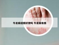 牛皮癣结根好使吗 牛皮癣有根