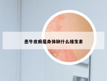 患牛皮癣是身体缺什么维生素