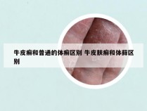 牛皮癣和普通的体癣区别 牛皮肤癣和体藓区别