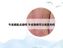 牛皮癣能点痣吗 牛皮肤癣可以用激光吗