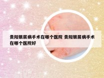 贵阳银屑病手术在哪个医院 贵阳银屑病手术在哪个医院好