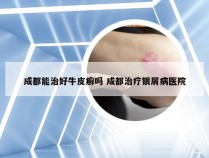 成都能治好牛皮癣吗 成都治疗银屑病医院