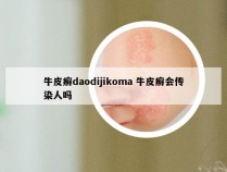 牛皮癣daodijikoma 牛皮癣会传染人吗