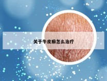 关于牛皮癣怎么治疗